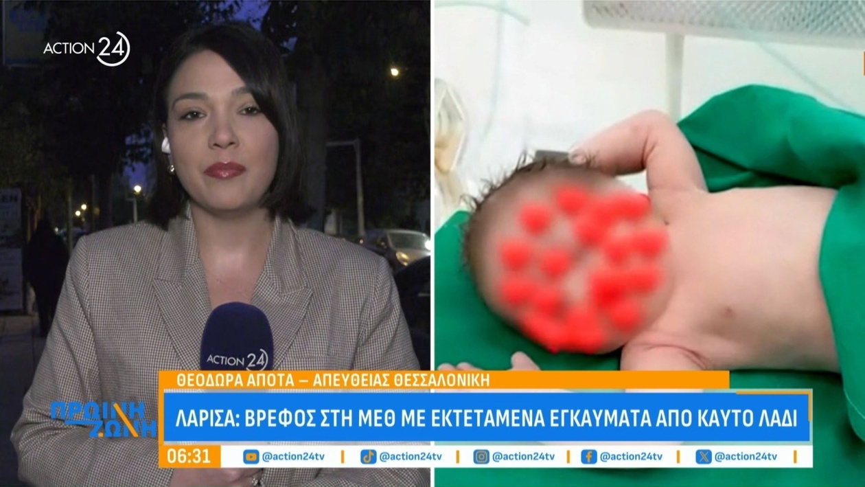 Ένα βρέφος στη ΜΕΘ της Λάρισας με εκτεταμένα εγκαύματα από καυτό λάδι