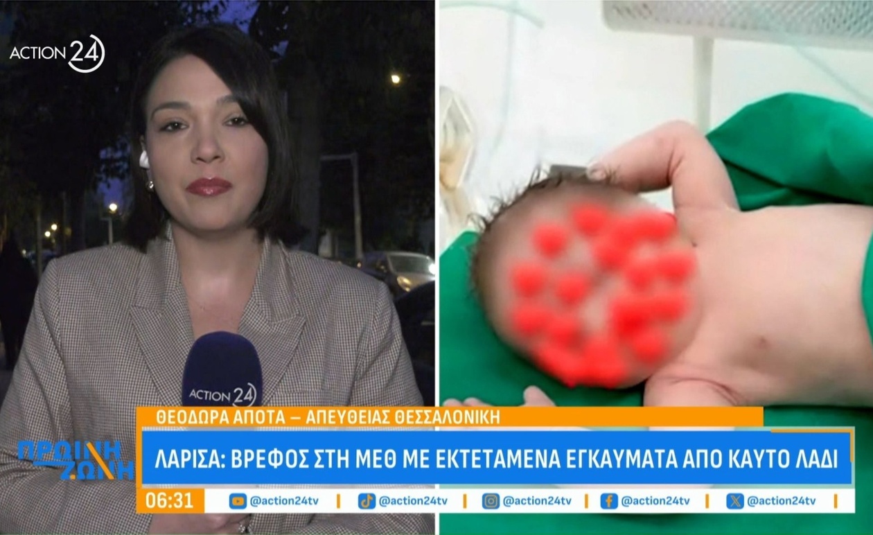 Ένα βρέφος στη ΜΕΘ της Λάρισας με εκτεταμένα εγκαύματα από καυτό λάδι