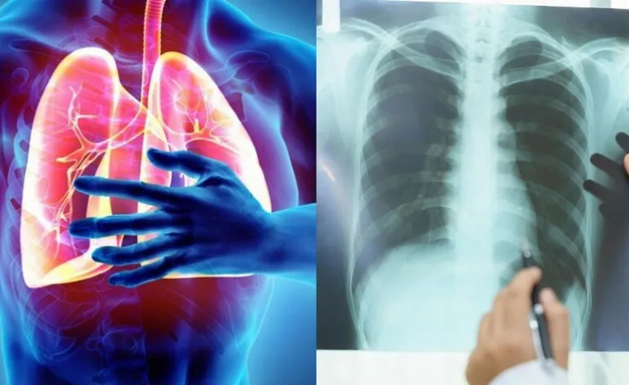 4 μύθοι για τον καρκίνο του πνεύμονα που πρέπει να πάψουμε να πιστεύουμε