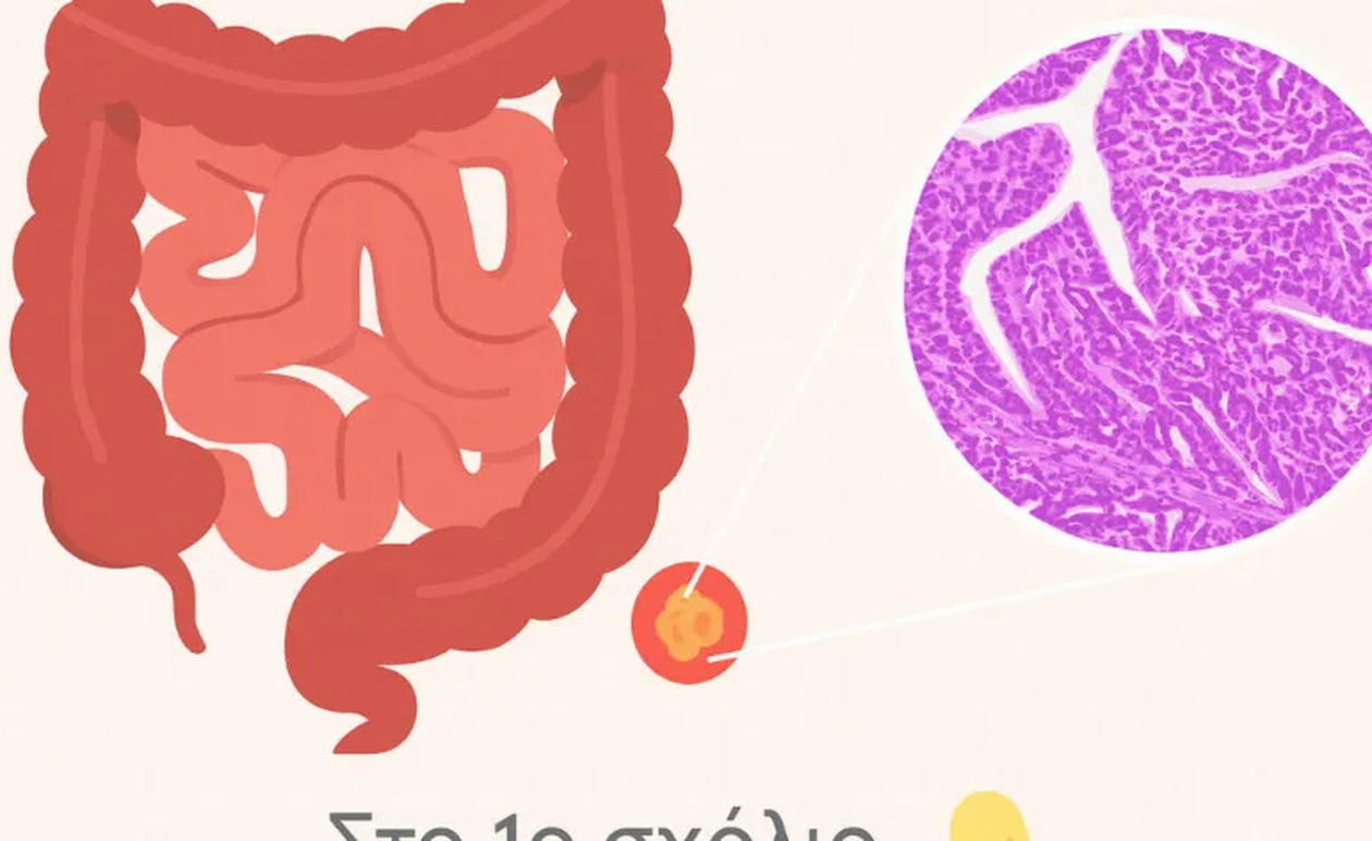 Το έντερο “μιλάει”: 5 πράγματα που δεν πρέπει να αγνοούμε για τον καρκίνο του παχέος εντέρου