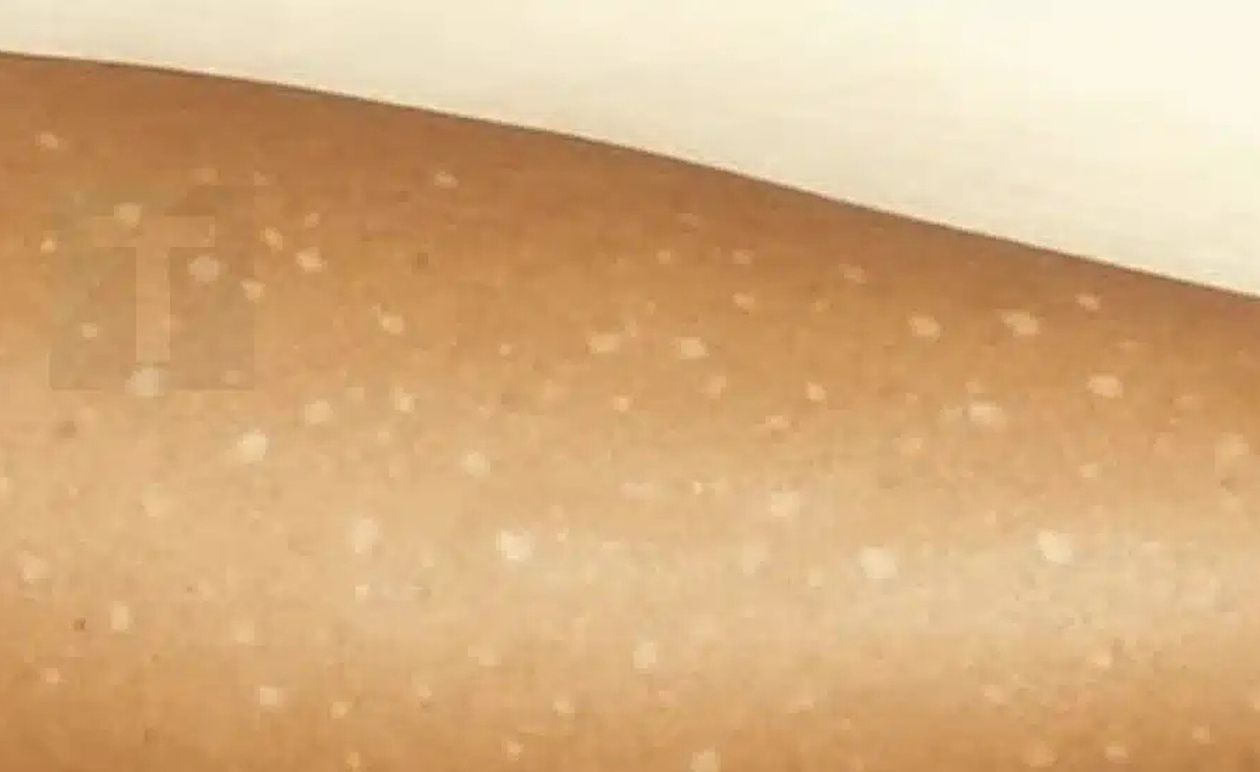 Λευκές κηλίδες στο δέρμα: Ποιες ελλείψεις βιταμινών μπορεί να είναι η αιτία;